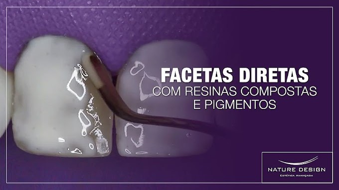 FACETAS DIRETAS com Resinas Compostas e Pigmentos - Leonardo Muniz