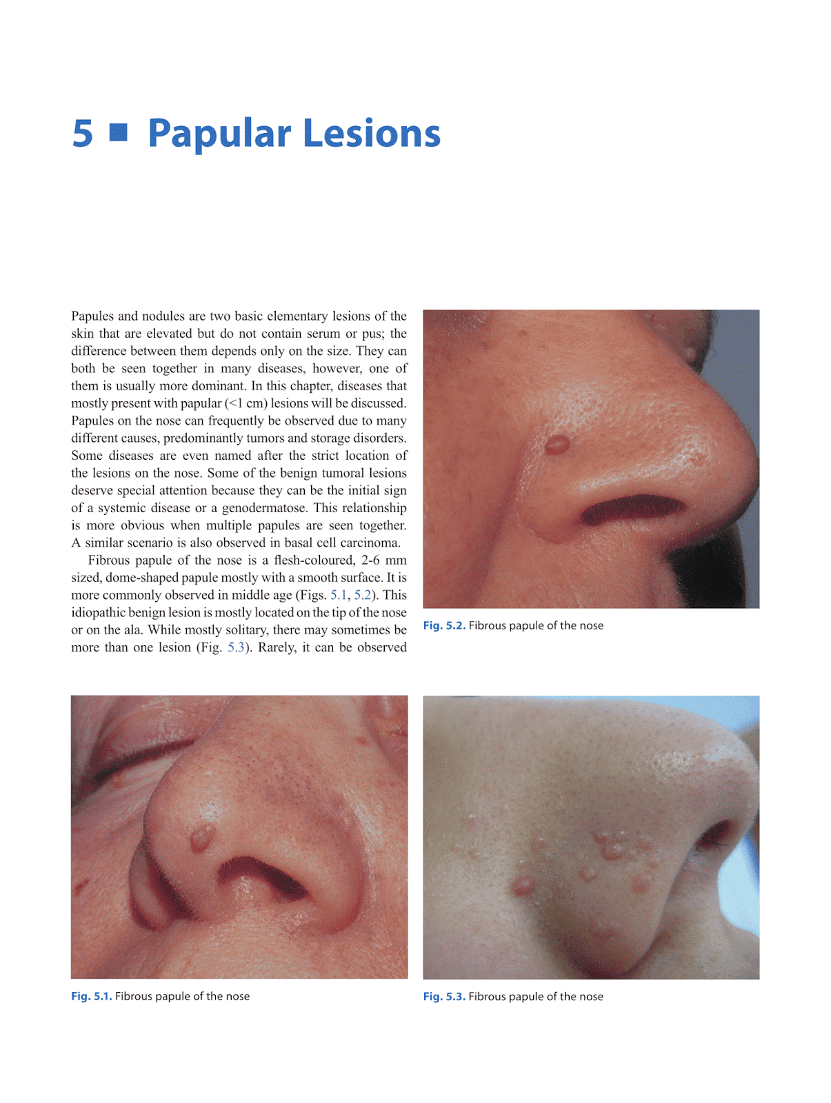 Otolaryngology by Alexandros G.Sfakianakis Papular Lesions of the Nose