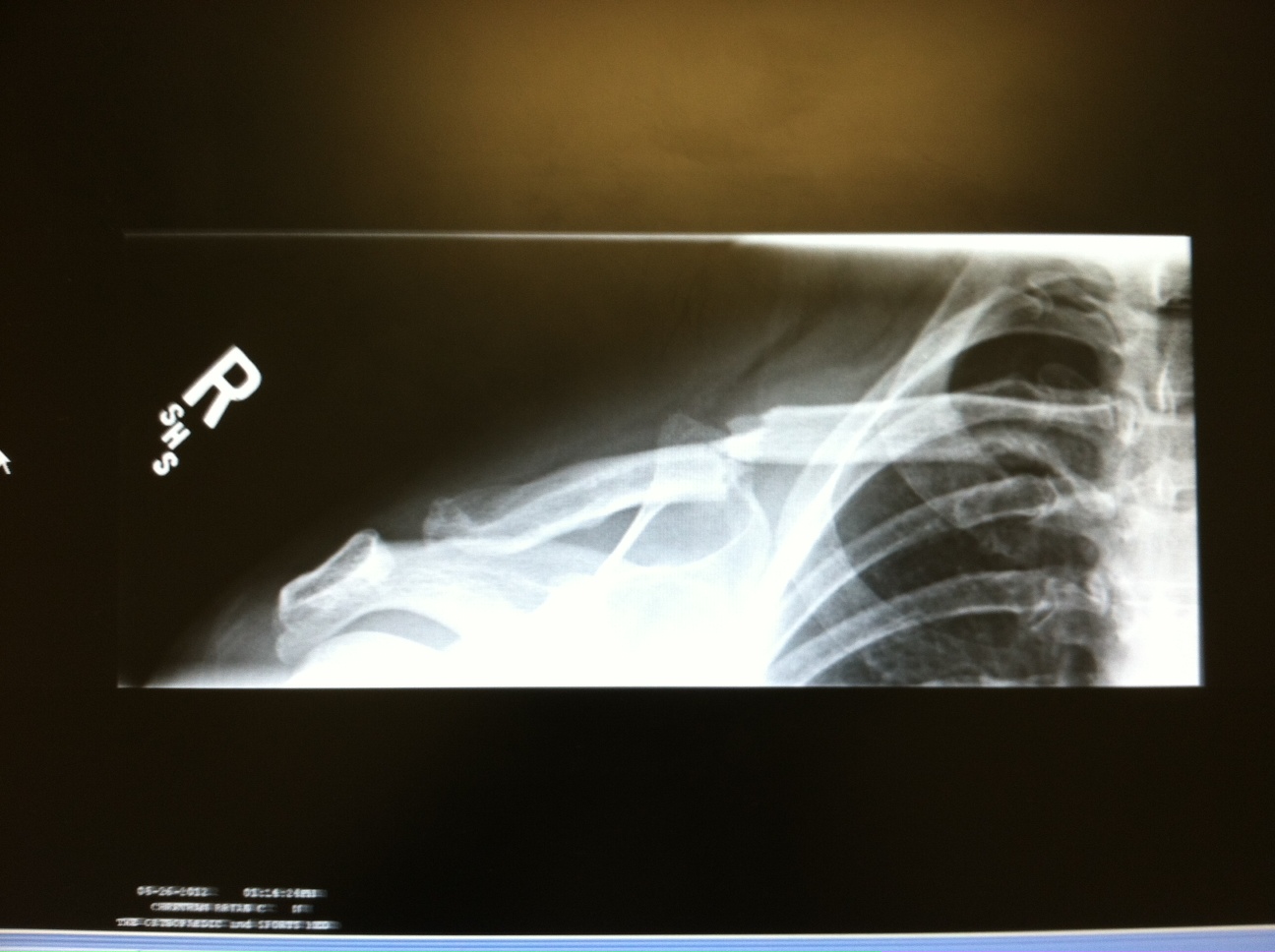 Broken Collarbone Blog