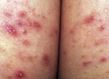 folliculitis on buttocks #10