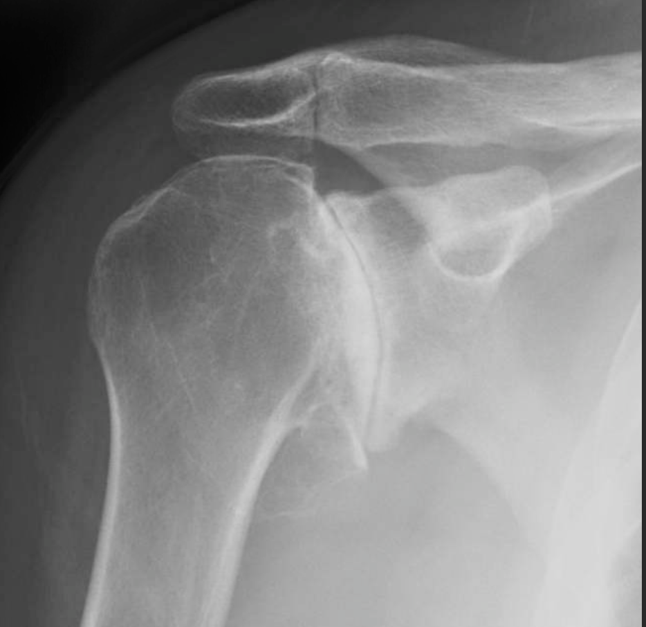 Лечение ключично акромиального артроза. Остеоартроз плечевого сустава рентген. Артрозо-артрит плечевого сустава рентген. Артрит плечевого сустава рентген. Ревматоидный артрит плечевого сустава рентген.