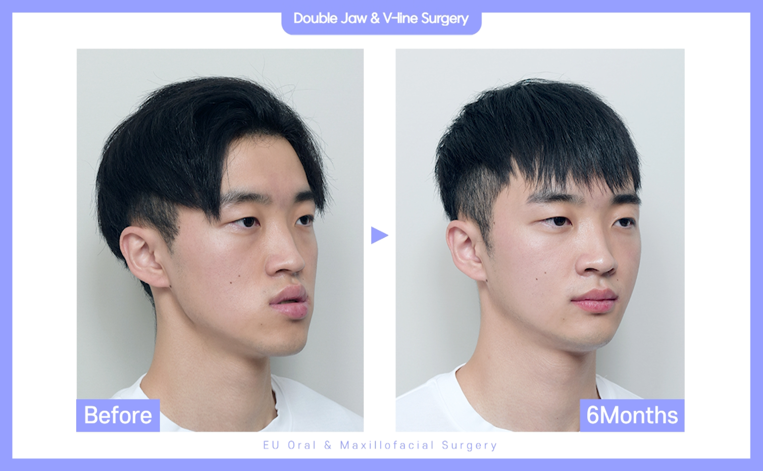 Male Orthodontic Surgery (Braces)_In Korea