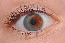 ما هى أسباب تغير لون إحدى العينين عند بعض الأشخاص؟