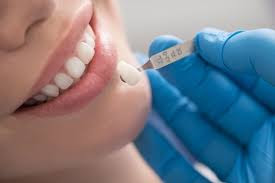 Veneers teeth Pros and Cons