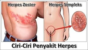 macam macam herpes macam macam herpes