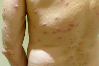 What do Bed Bug Bites Look Like