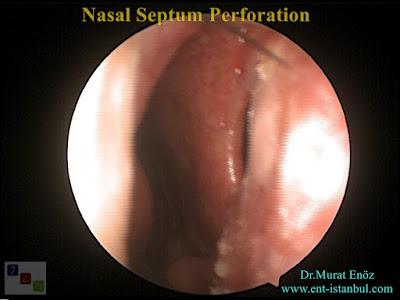 Nasal Septum Perforation