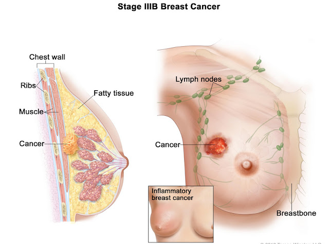 What do breast cancer lumps feel like What do breast cancer lumps feel like