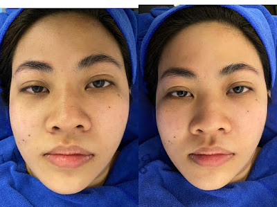 Before and after BTL Exilis Ultra 360 face 2 shy pte ltd