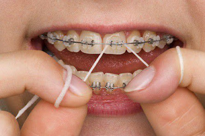 Niềng răng có cần nhổ răng không?
