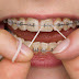 Nhổ răng khi niềng răng có tác hại gì?