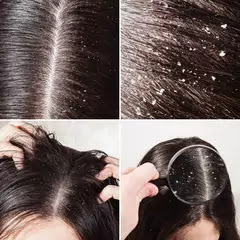 Does Dandruff Cause Hair Loss Does Dandruff Cause Hair Loss