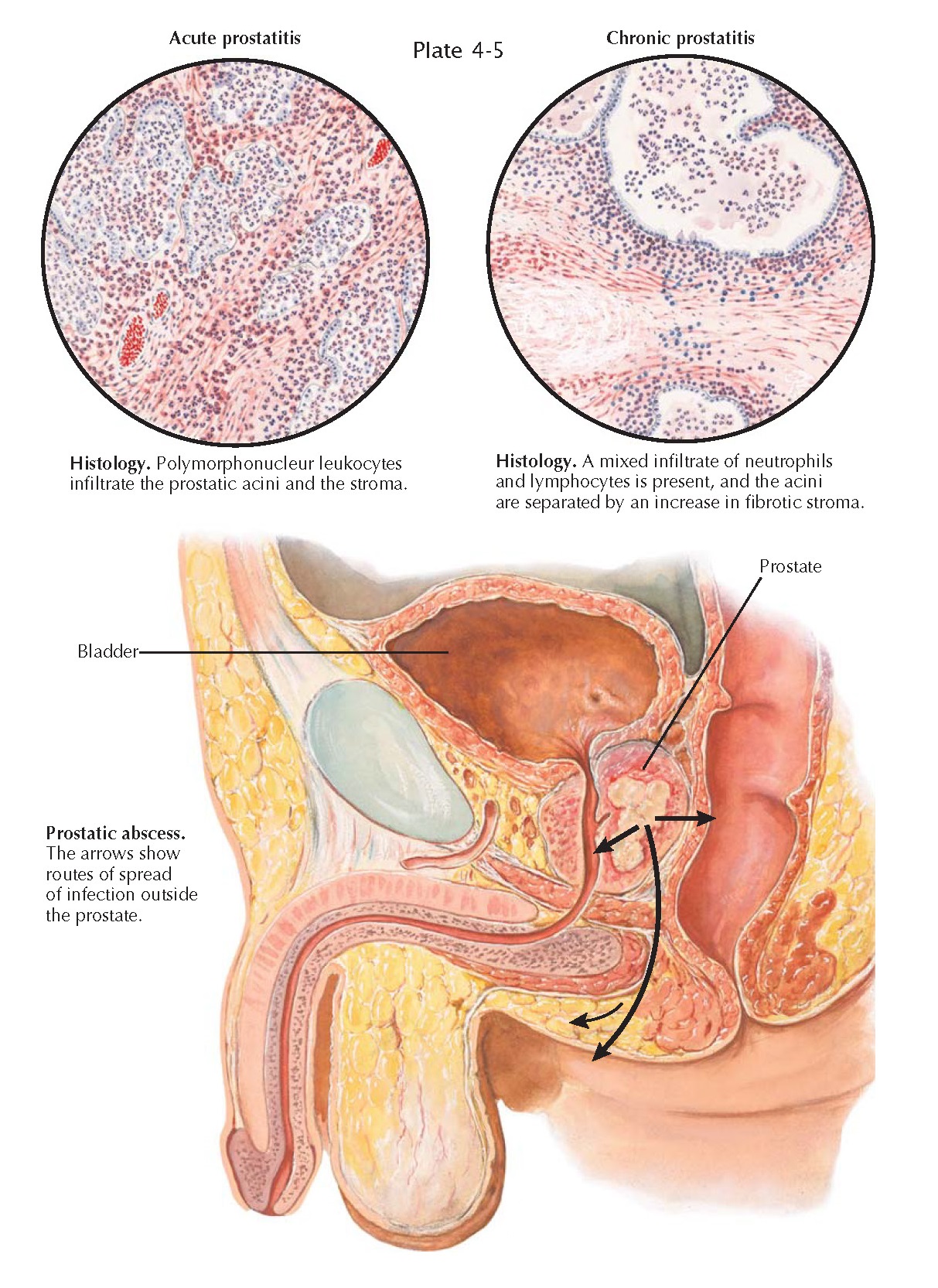 boggy prostate definition)