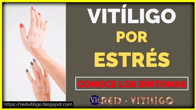 Vitiligo por estrés síntomas