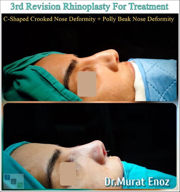 3rd Revision Rhinoplasty For Treatment of "C-Shaped Crooked Nose Deformity" + "Polly Beak Nose Deformity"