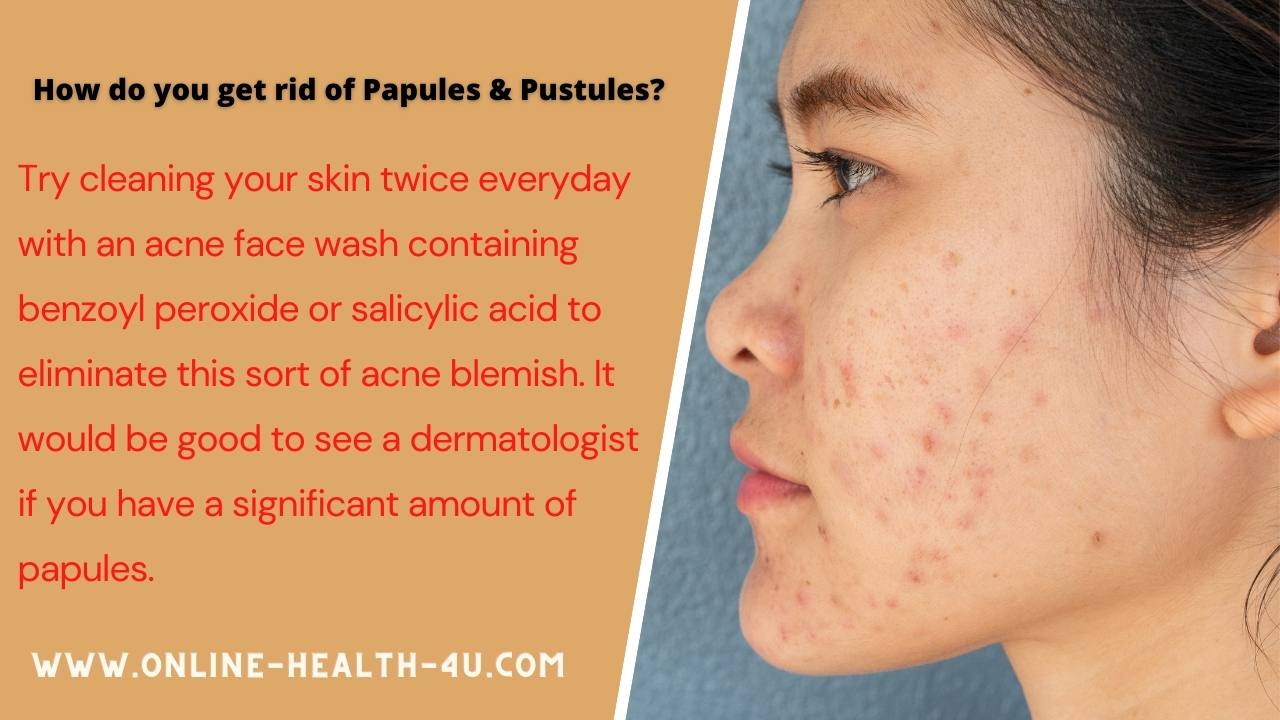 papules-pustules-causes-symptoms-treatment