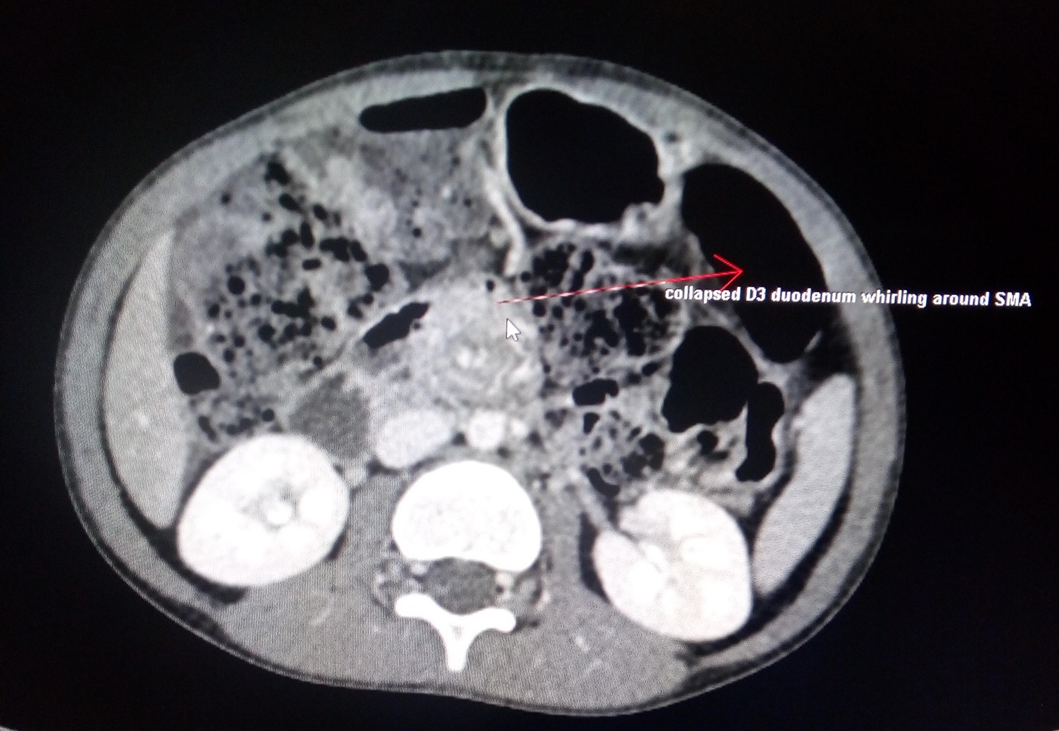 Midgut Volvulus CT Sumer's Radiology Blog