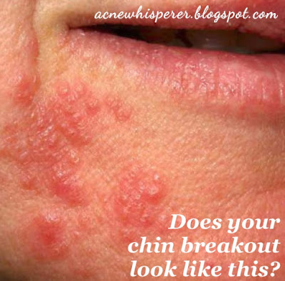 Peri-Oral Dermatitis could be the answer you've been searching for.