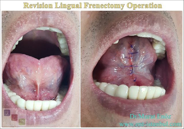 Frenotomy, Frenulotomy, Frenulectomy, Revision Lingual Frenectomy, Tongue Tie Release Surgery