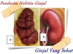 Kelainan Dan Penyakit Pada Ginjal (Batu Ginjal, Nefritis, Diabetes