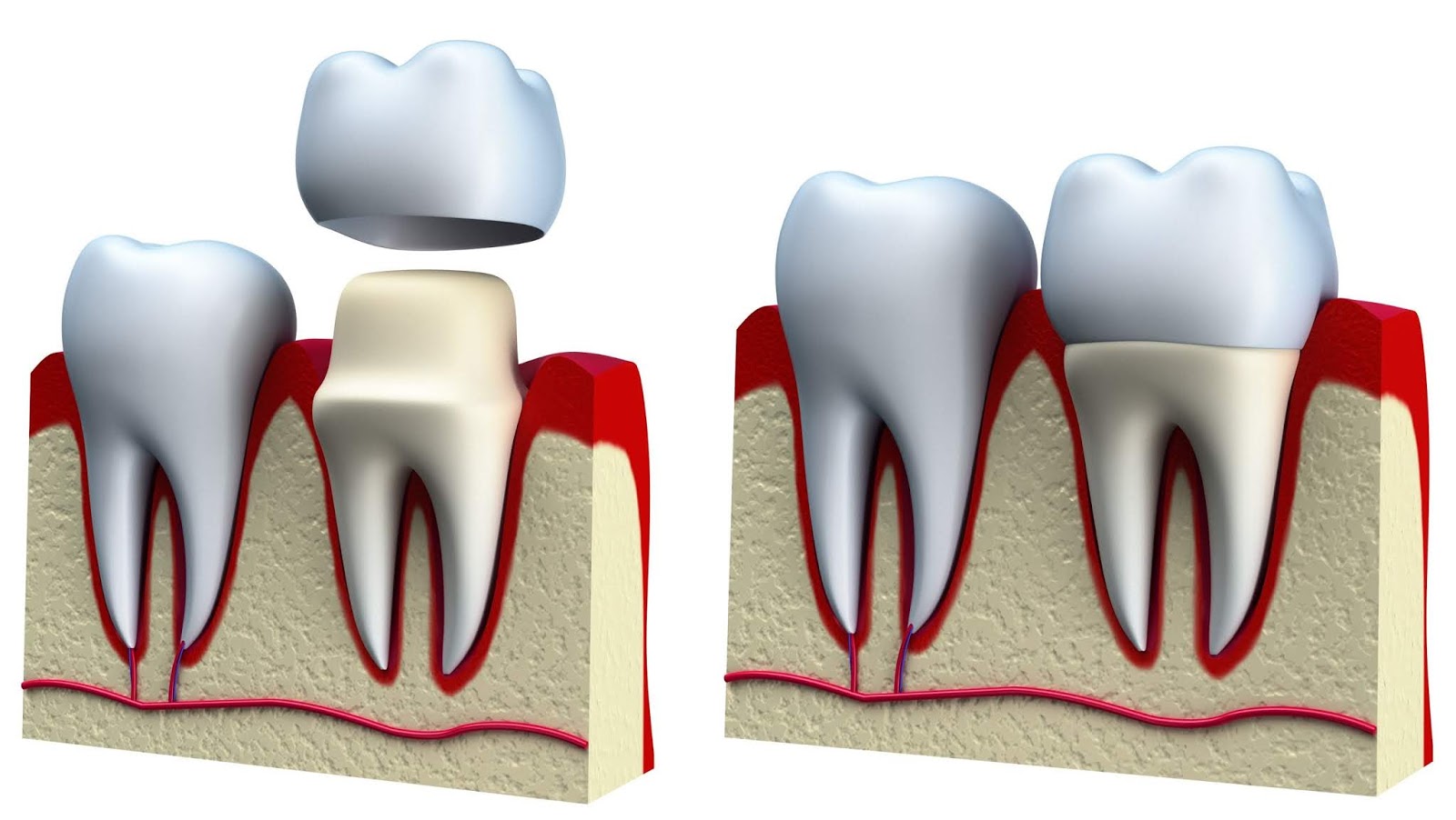 What is Dental Crowns? Why Dental Crowns is needed?