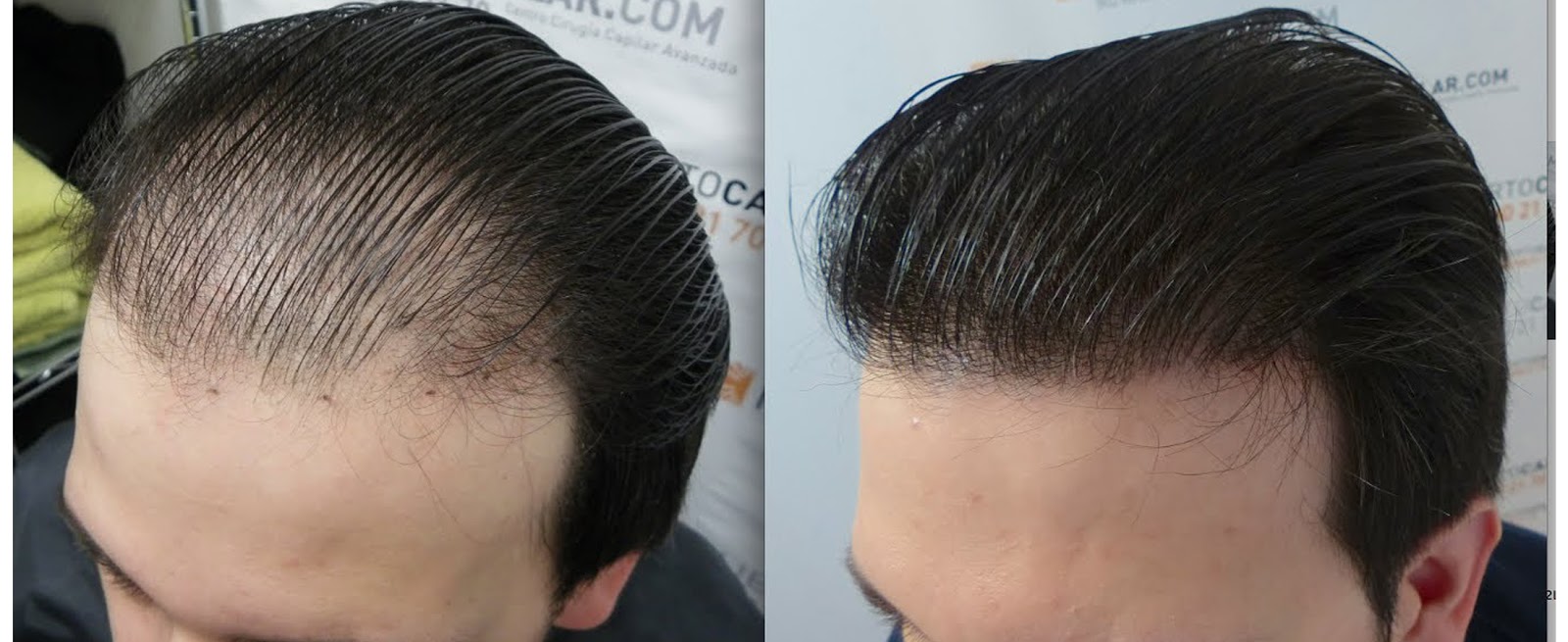 (زراعة الشعر في السعودية) Follicular Hair Transplants SIZZLING BUZZ