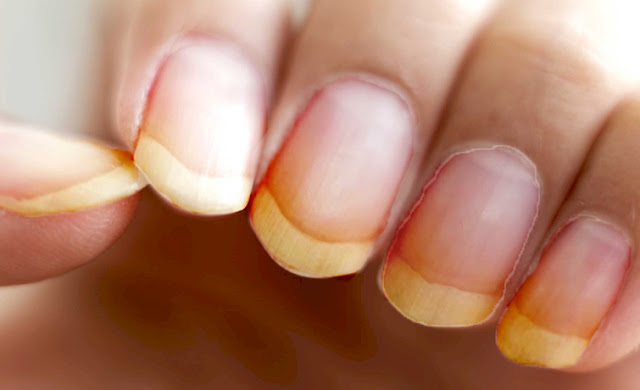 Pourquoi le vernis jaunit-il mes ongles ?