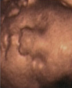 Hafta hafta bebeğin ultrason görüntüleri-32.hafta