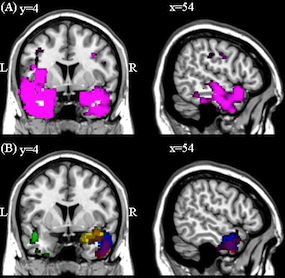 brain piguet Alzheimer