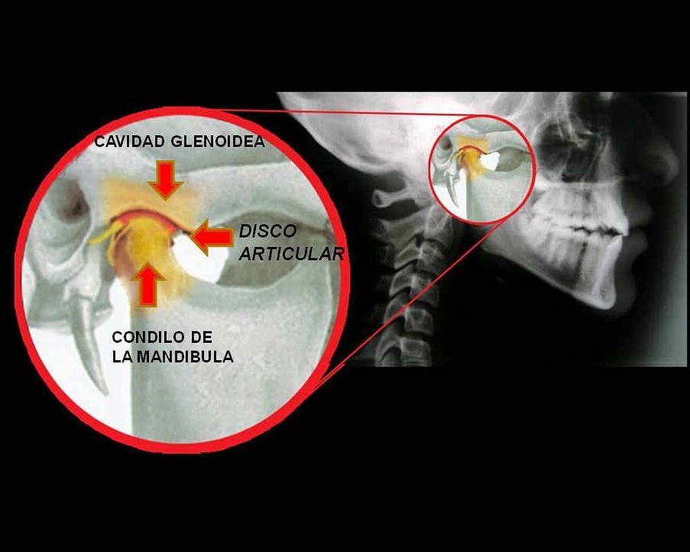 Mandibula travada?! Ig gess.soad #boca #mandibula #trismo #dentista #s