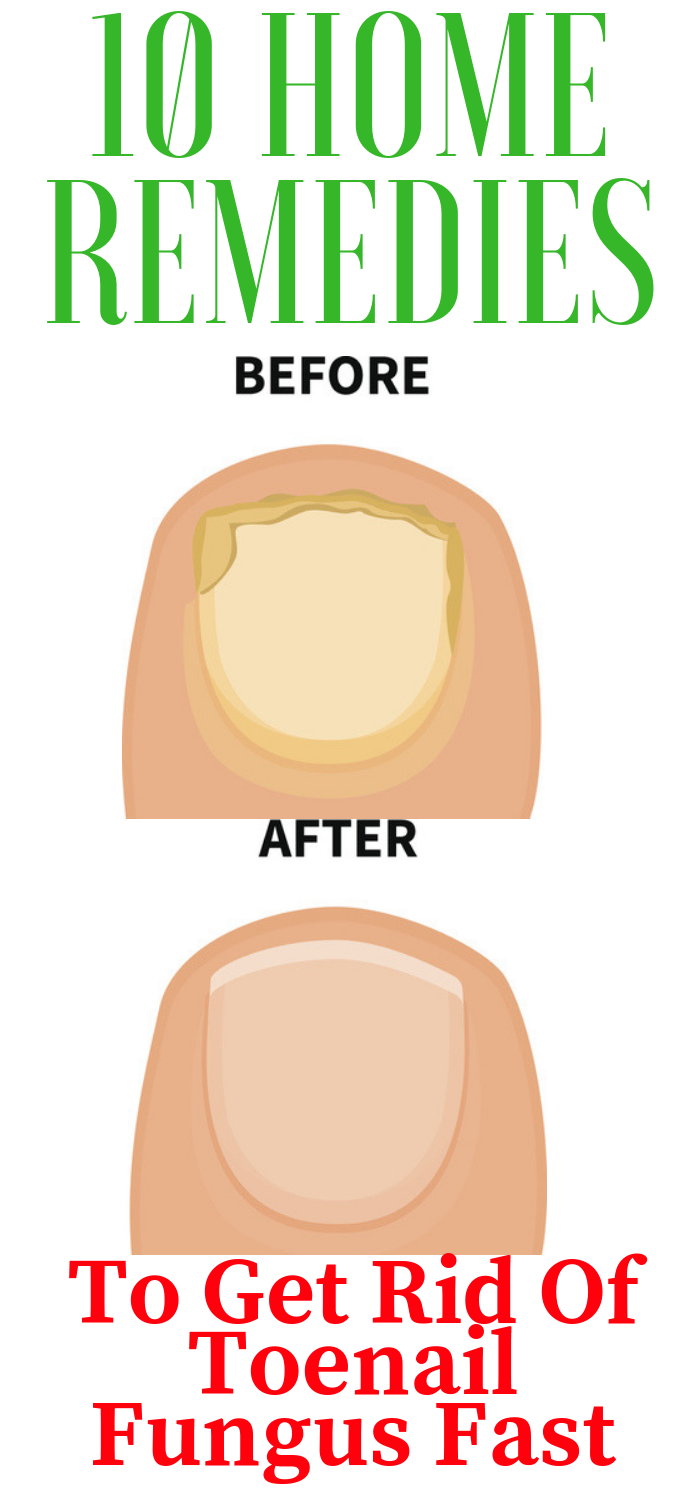 Run Healthy Lifestyle 10 Home Remedies To Get Rid Of Toenail Fungus Fast