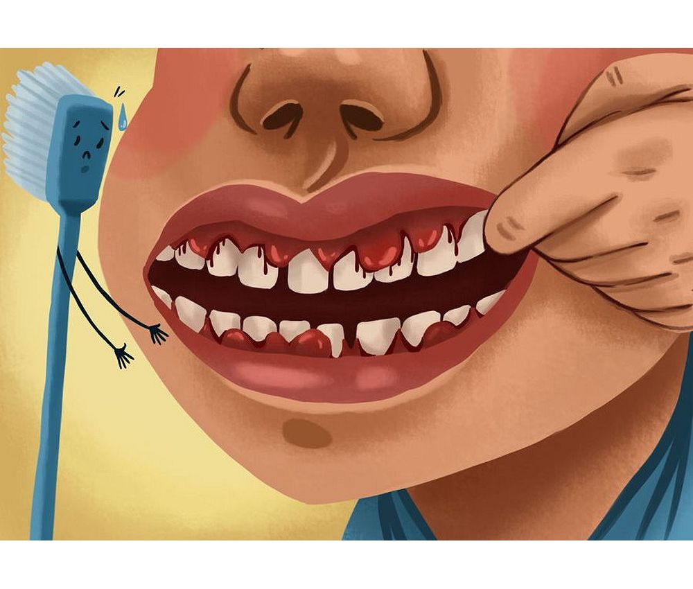 ¿Sangrado de encías? Mucho cuidado con su salud bucal OdontoVida