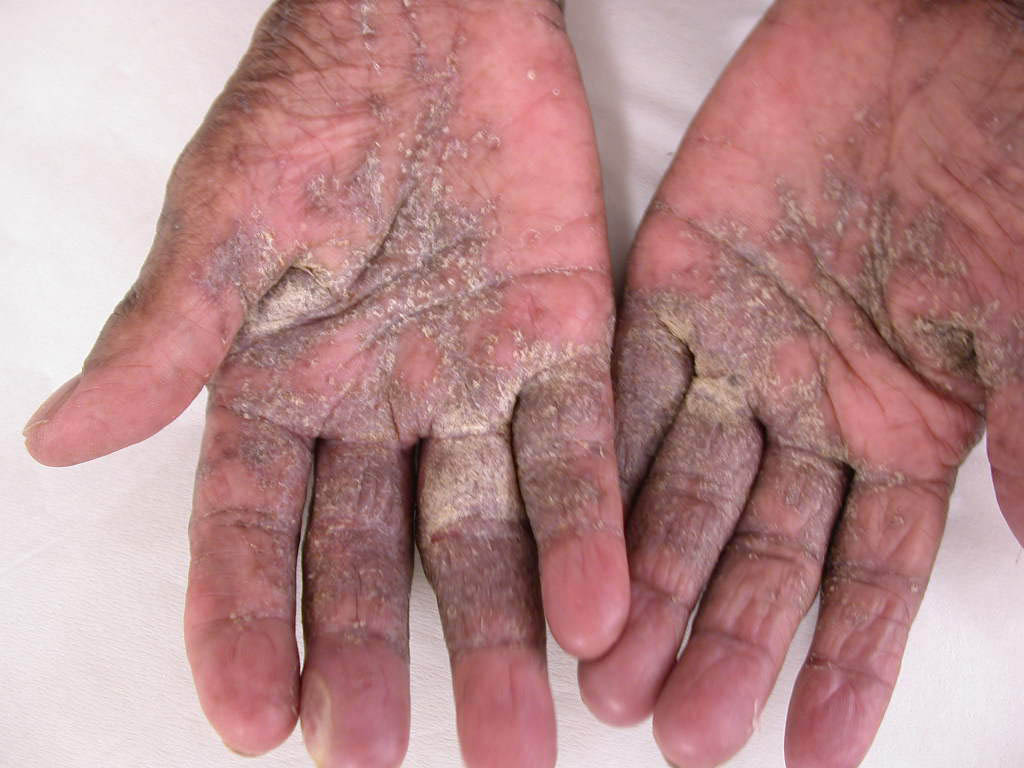 scabies on palm