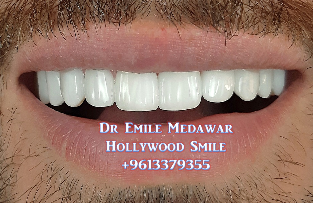 Hollywood Smile Clinic,Dr Emile Medawar, 00 961 3 379355 Hollywood Smile, Veneers, Dental