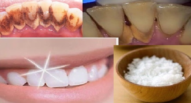 MENAKJUBKAN !! Gigi Anda Putih Cemerlang Hanya Dalam 1 Detik Dengan Bumbu Dapur Berikut Langkahnya