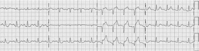Grade 2 spondylolisthesis l5 on s1 image