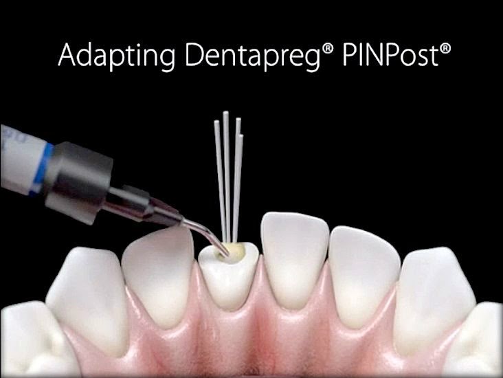 DENTAPREG PinPost Training