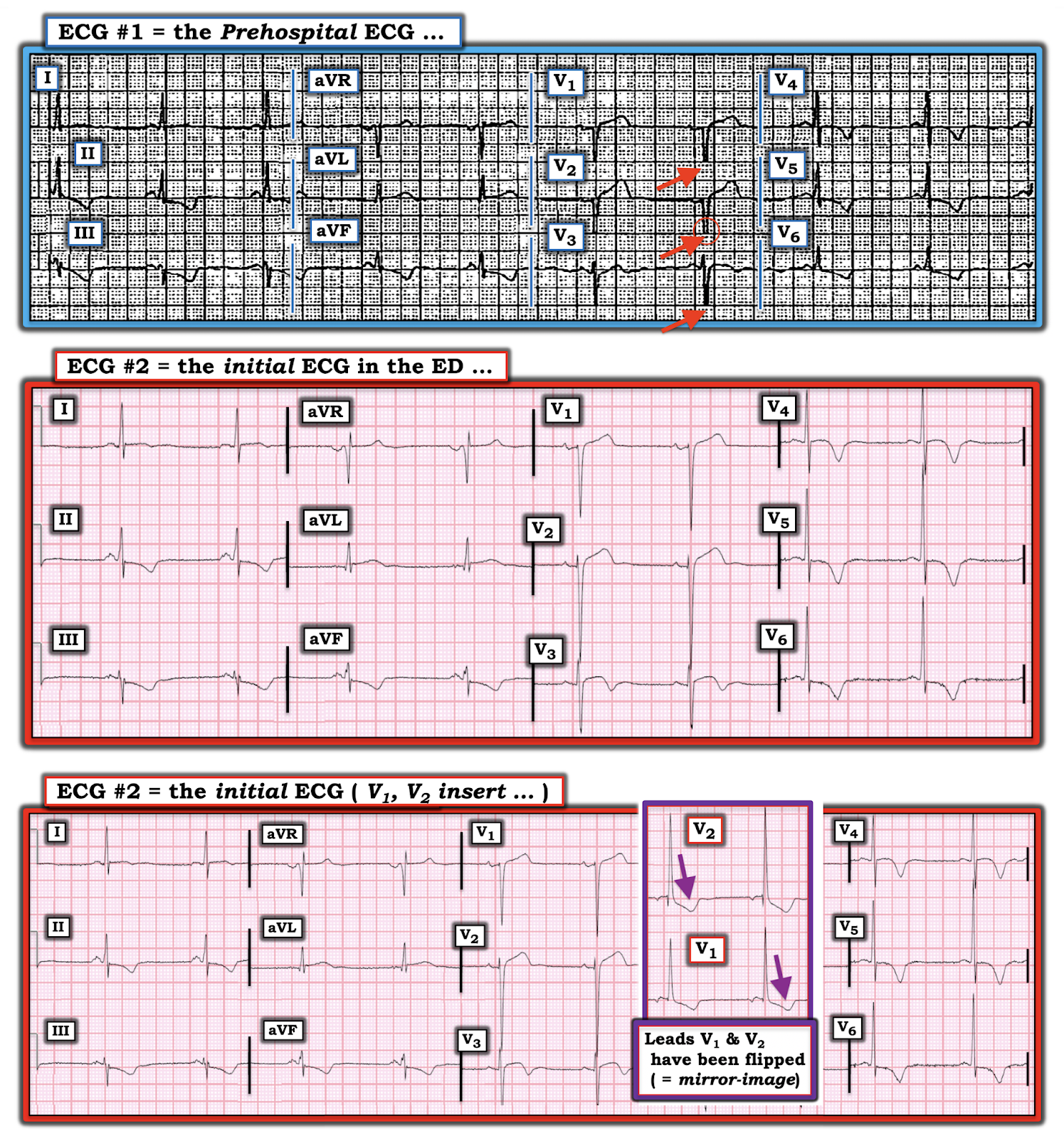 Dr. Smith's ECG Blog Syncope and Prehospital Cath Lab activation