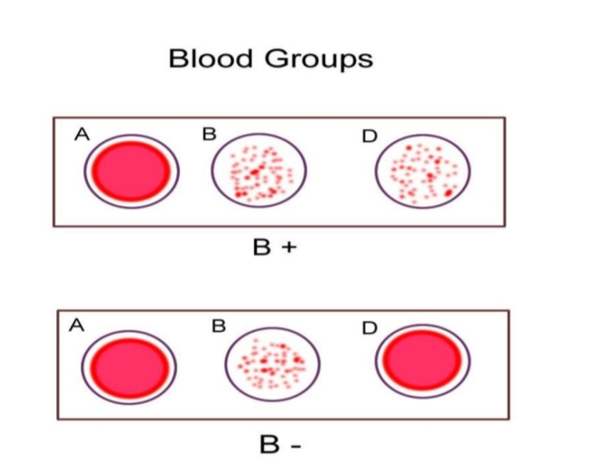 Blood Grouping and Crossmatching Pdf Notes for BMLT DMLT