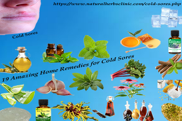 19 Amazing Home Remedies for Cold Sores