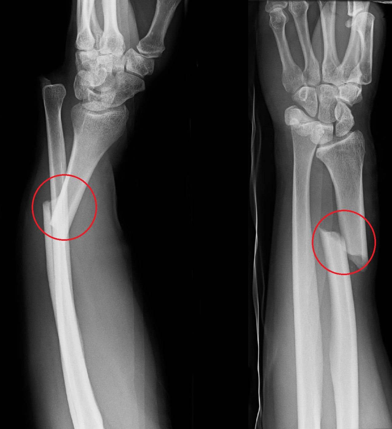 Galeazzi Fracture Treatment Galeazzi Bone Fracture Surgery