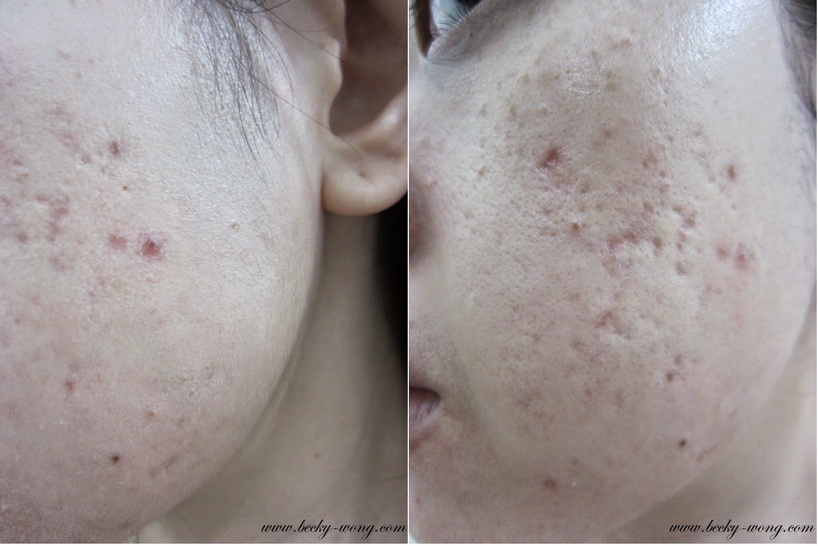 Beauty] My Acne Treatment Mario Badescu |