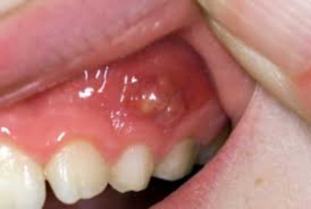 Cara Mengatasi Gusi Bengkak Secara Alami - Masalah gangguan mulut yang sering terjadi pada sebagian orang selain gigi berlubang adalah gusi bengkak. Gusi bengkak  merupakan keadaan dimana terjadinya pembengkakkan pada gusi. 