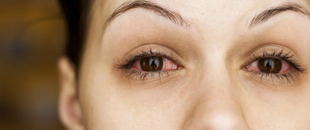 اسباب احمرار العين والتهابات العين و حالات العين الخطرة 👀