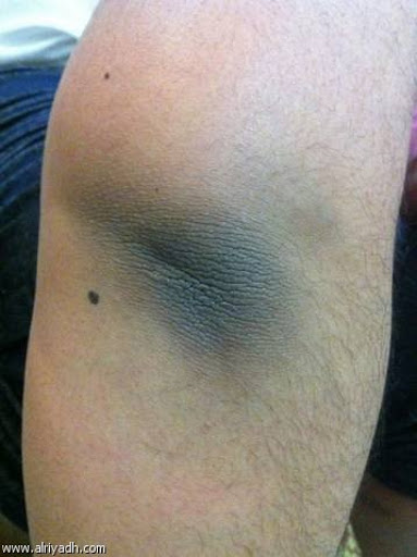 د ماهر محمود علاج سواد أو سواد الركب والأكواع