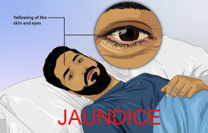 Jaundice What is Jaundice And Its Symptoms