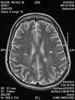 MRI of MS brain