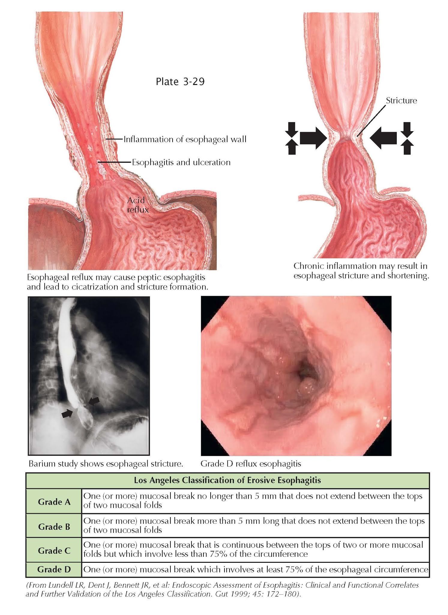 Reflux Esophagitis pediagenosis