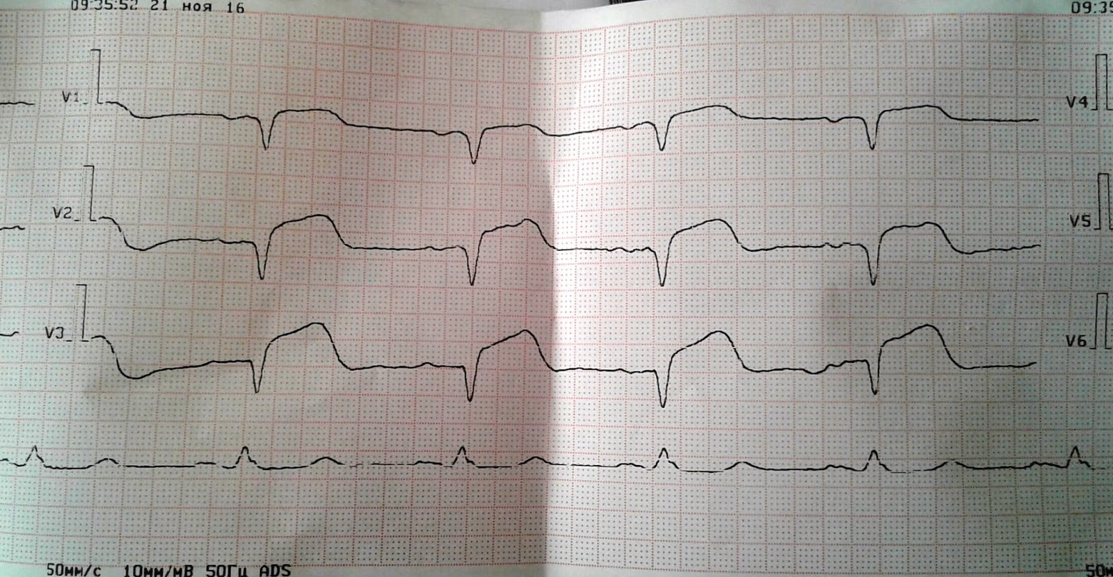 Карта вызова смп окс c подъемом st локальный