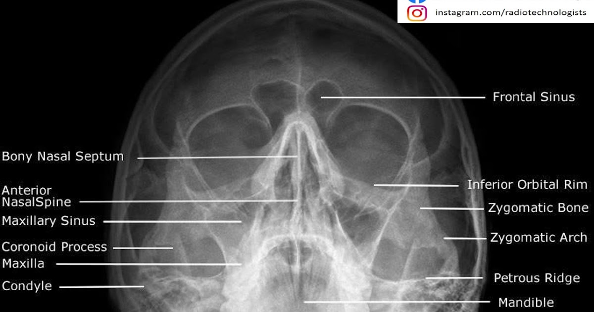 الاشعة العادية على الجيوب الانفية P N S أخصائي تصوير اشعة
